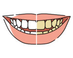 歯の色を比較するイラスト