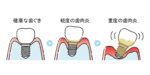 インプラント歯周炎になる過程のイラスト