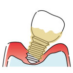 インプラント歯周炎（重度）のイラスト