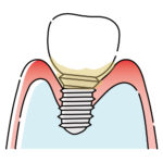 インプラント歯周炎（軽度）のイラスト