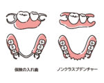 保険の入れ歯とノンクラスプデンチャーの比較のイラスト