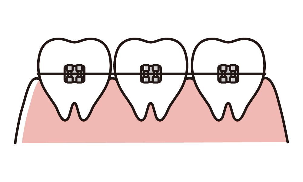 シンプルな歯科矯正のイラスト