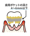 中等度歯周病のイラスト