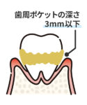 軽度歯周病のイラスト